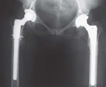 Illustration 99 for Successful Total Hip Replacement in Developmental Dysplasia
