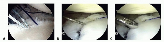 Illustration 24 for Regain Stability: Arthroscopy for Anterior Instability & the Inferior Glenohumeral Ligament