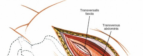 Illustration 13 for Master the Anterolateral Retroperitoneal Approach to Lumbar Spine