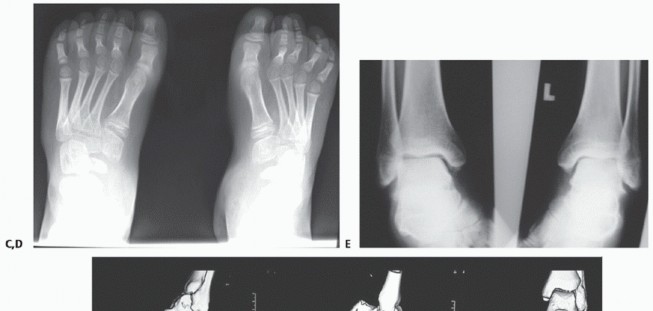 Illustration 4 for How Achilles Tendon Lengthening Fixes Equinocavovarus Foot