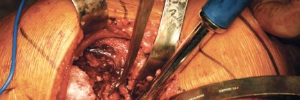 Illustration 25 for Metal on Metal Resurfacing: Enhanced Posterior Soft Tissue Repair