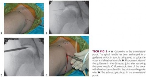 Illustration 180 for Understanding Hip Arthroscopy: The Basics Explained