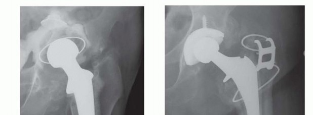 Illustration 5 for Resection Arthroplasty & Spacers: Optimizing Time of Reimplantation