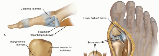Cheilectomy for Hallux: Find Relief from Rigidus Pain