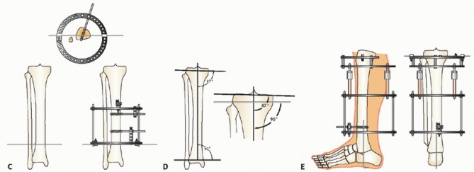Illustration 16 for Beyond Amputation: Circular Fixation for Infection of the Talus