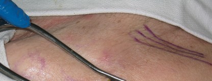 Illustration 10 for Minimally Invasive THA: Navigating Techniques, Benefits & Pitfalls