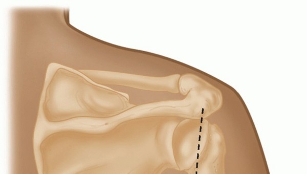 Illustration 11 for Finally Treat Recurrent Posterior Instability of the Shoulder