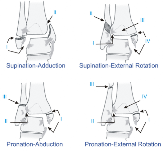 Illustration of fracture ankle fracture ankle - Dr. Mohammed Hutaif