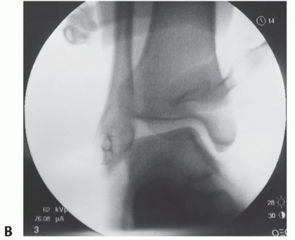 Illustration 2 for Lateral Ankle Repair: Maximize Stability with Interference Screw Fixation