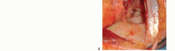 Stop Ulnar Nerve Symptoms: Medial Elbow Contracture Release