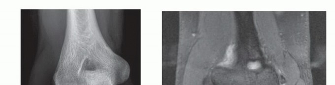 Elbow Arthroscopy for Panner Disease and Osteochondritis: Relief for Young Athletes