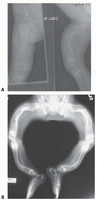Less Pain, More Function: Fassier-Duval Nailing for Osteogenesis Imperfecta