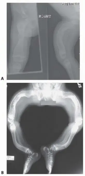 صورة توضيحية لـ مرض العظم الزجاجي (هشاشة العظام الوراثية): أمل جديد لعائلاتكم مع الأستاذ الدكتور محمد هطيف