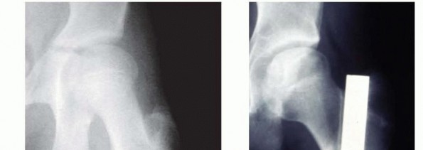 Illustration 5 for Pediatric Femoral Nailing: Targeting the Right aspect of the greater Trochanter