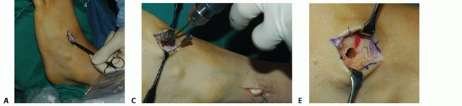 Illustration 14 for Restore Movement: Tendon Transfer for Common Peroneal Nerve Foot Drop