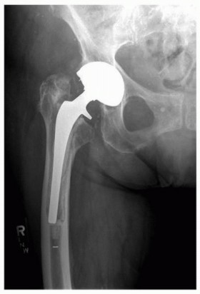 Illustration 7 for Mastering Revision THA: Strategies for Adverse Local Tissue Challenges