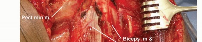 Illustration 24 for Limb-Sparing Resections Around the Shoulder: Optimizing Outcomes