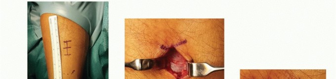 Regaining the position of the ankle: Mini-Open Achilles Repair