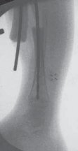 Illustration 11 for Solving Congenital Pseudarthrosis: Tibia with the Williams Rod
