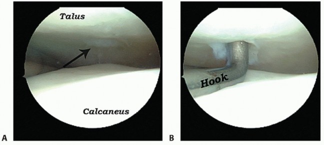 Illustration 14 for Posterior Talar Process: Endoscopic Solutions for Ankle Pain