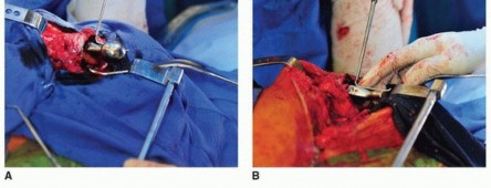 Illustration 11 for Cement in Cement Revision: Simplifying Complex Hip Revisions