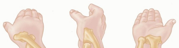 Mastering Radial Head ORIF: Approximating Perfect Fracture Repair