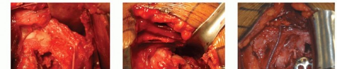 Illustration 18 for Optimizing Fixation of Proximal Humerus Fractures: A Guide