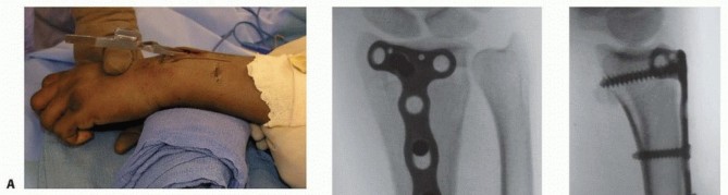 Illustration 13 for Distal Radius Fixation: Precision Through Lister's Tubercle
