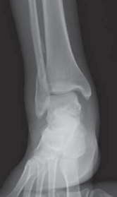 Illustration 13 for Optimal Fixation of the Ankle: Open Reduction & Internal Fixation