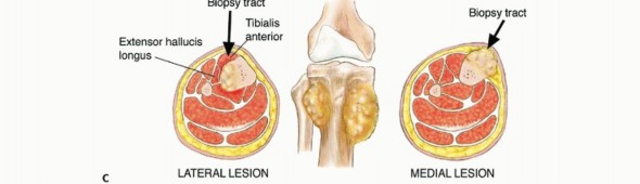 Illustration 36 for Precision Biopsy of Musculoskeletal Tumors for Accurate Diagnosis