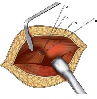 Illustration 75 for Metal on Metal Resurfacing: Enhanced Posterior Soft Tissue Repair