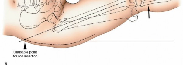 Illustration 63 for Optimal Femoral Approaches: Mastering the Lateral Intermuscular Septum