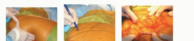 Illustration 44 for Hemiarthroplasty of the Hip: Indications & Types Explained