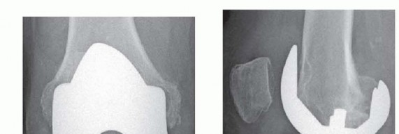 Bone Loss Bone Grafting for Challenging Tibial Defects