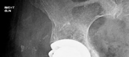Acetabular Augment: Rebuilding Bone in Complex Revision