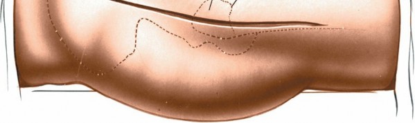 Illustration 102 for Unlocking Every Aspect of the Hip's Surgical Approaches