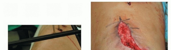 Illustration 31 for Repairing Distal Femur Fractures: Open Reduction & Internal Fixation