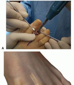 Illustration 33 for Hammer Toe Correction: Understanding the Extensor Digitorum Longus