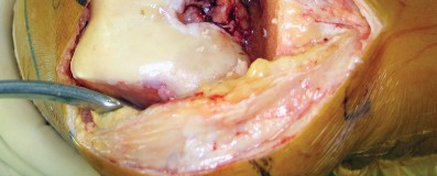 صورة طبية: استبدال مفصل الركبة بالحد الأدنى من التدخل الجراحي: ألم أقل وتعافٍ أسرع مع النهج شبه الرضفي الإنسي