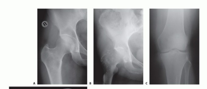 Illustration 2 for Mastering Femoral Metastases: Optimal Function for Femoris & Vastus