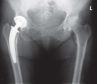 Illustration 79 for Collum Femoris Preserving: Achieve Better Primary Hip Outcomes