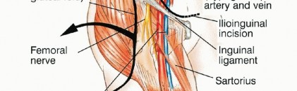 Illustration 18 for Surgical Pelvic Resection: Gluteus Maximus Muscle & Nerve Preservation