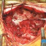 Illustration 13 for Cervical Fusion: The Line is Drawn for Lasting Stability