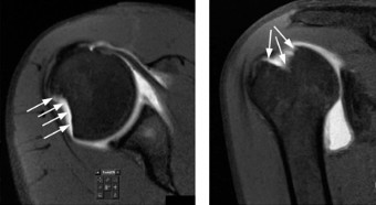 Illustration 18 for Right Shoulder Pain? Avoid This Common X-ray Mistake.