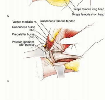 Illustration 20 for Limb-Sparing Quadriceps Resection: Superficial Femoral Artery