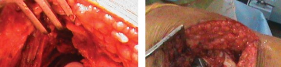 Illustration 42 for Considering METHA Short Stem? Discover Bone-Preserving THA