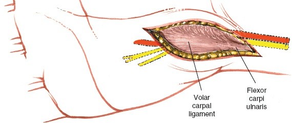 Illustration 86 for Essential Surgical Approaches: Uncover Every Aspect of the Wrist