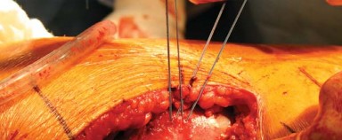 Illustration 33 for Posterolateral Surgical Approaches: Achieve Optimal Hip Replacement