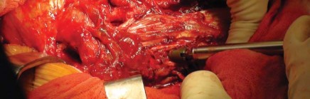 Illustration 13 for Effective Arthroplasty for Salvage of Failed Hip Fixation