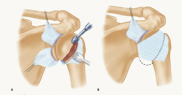 Illustration 17 for Mastering the Treatment of Recurrent Posterior Shoulder Instability